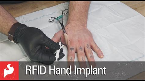 rfid chip implantat entfernen|rfid implantation in hand.